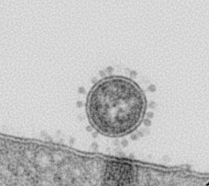 कोविड-१९ मेंदूत कायमस्वरूपी ठसे सोडतो का?